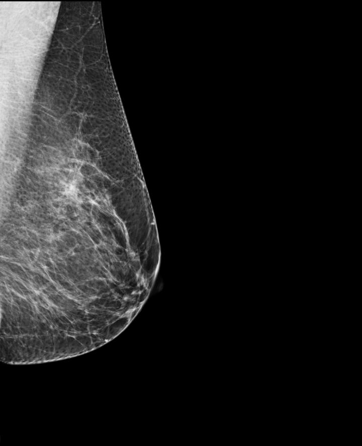 Myth: Getting annual mammograms exposes you to radiation that can cause breast cancer.