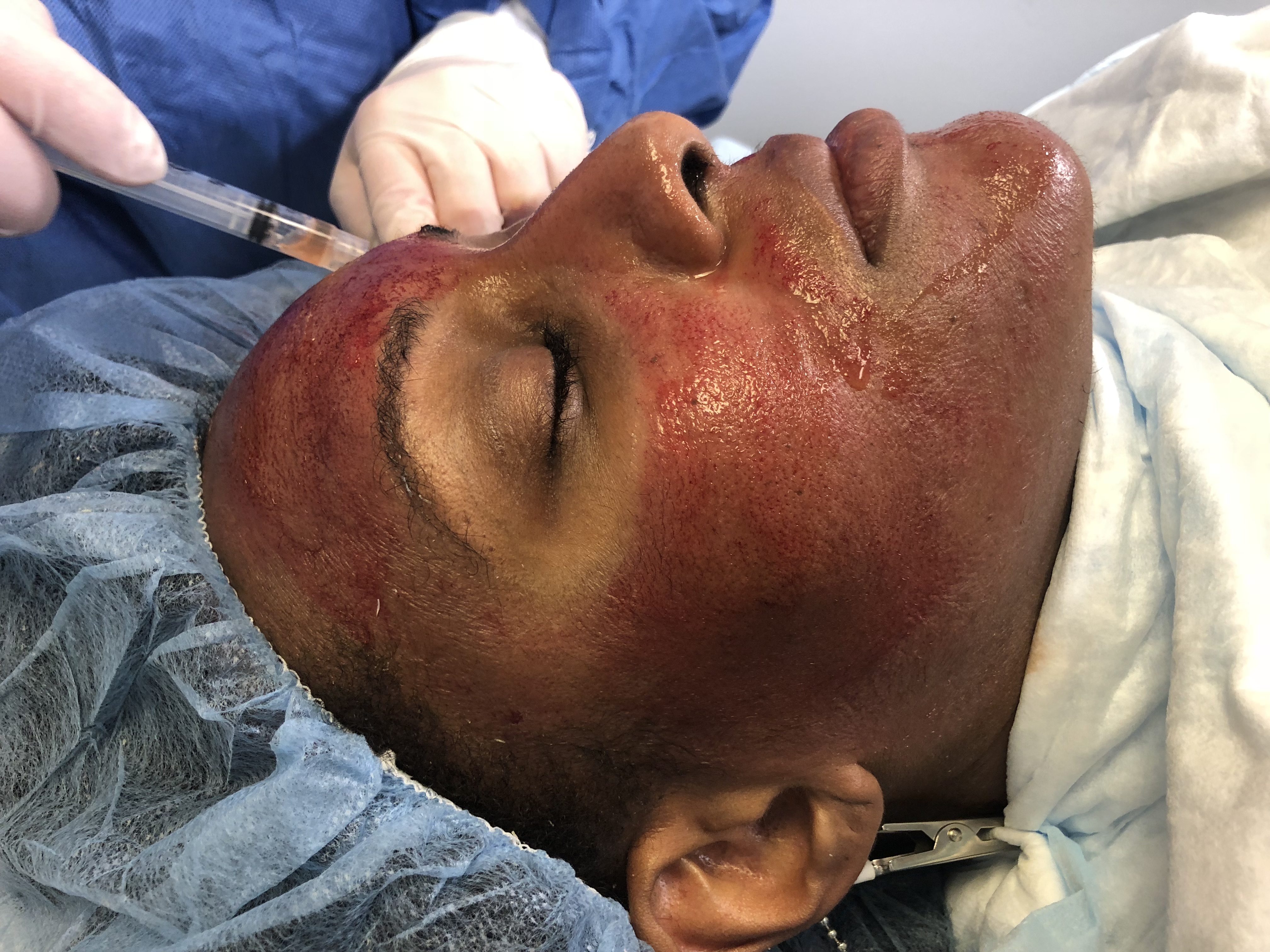 Vampire Facial aka PRP Facial