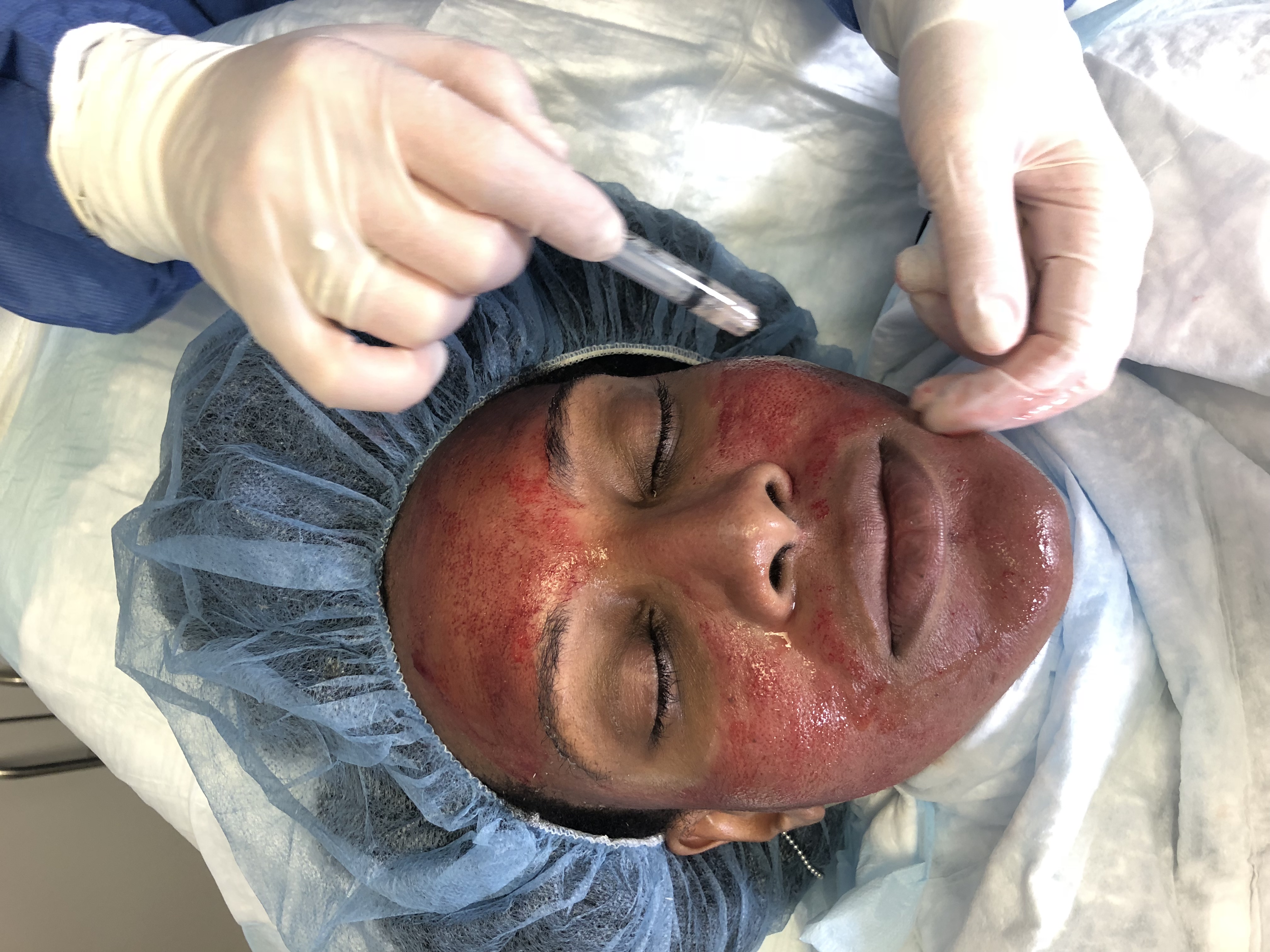 Vampire Facial aka PRP Facial