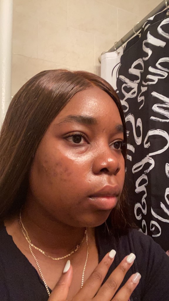 DRMTLGY 24 Hour Acne Serum Selfie